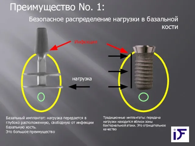 Преимущество No. 1: Традиционные имплантаты: передача нагрузки находится вблизи зоны бактериальной атаки.