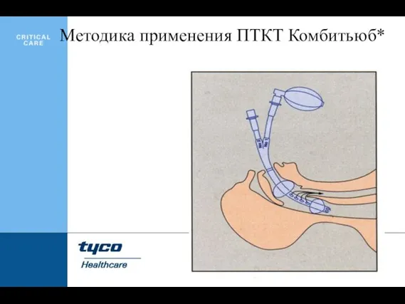 Методика применения ПТКТ Комбитьюб*