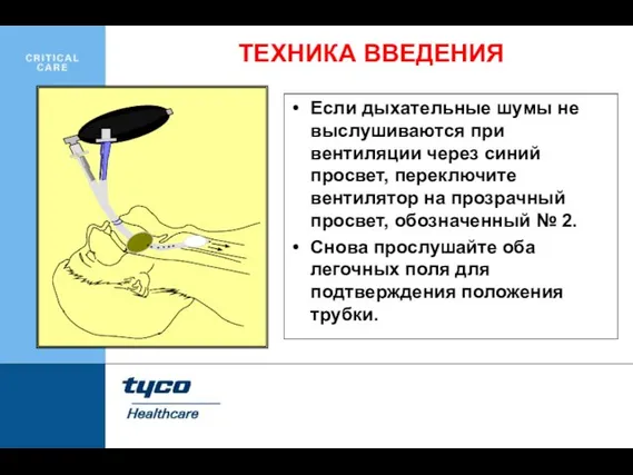 Если дыхательные шумы не выслушиваются при вентиляции через синий просвет, переключите вентилятор