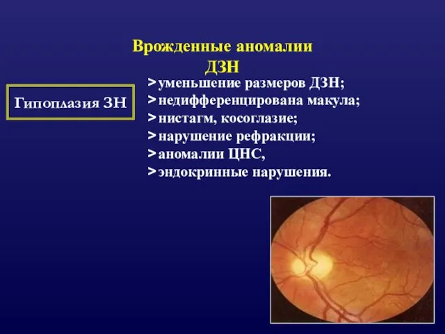 Врожденные аномалии ДЗН Гипоплазия ЗН уменьшение размеров ДЗН; недифференцирована макула; нистагм, косоглазие;