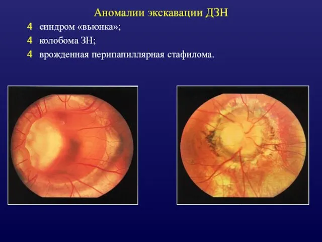 Аномалии экскавации ДЗН синдром «вьюнка»; колобома ЗН; врожденная перипапиллярная стафилома.