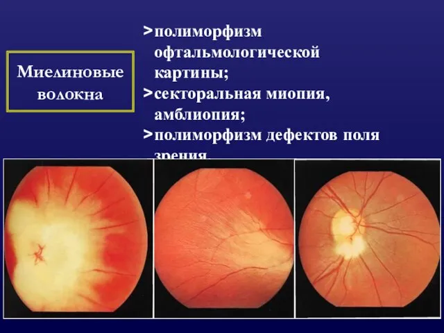 Миелиновые волокна полиморфизм офтальмологической картины; секторальная миопия, амблиопия; полиморфизм дефектов поля зрения.