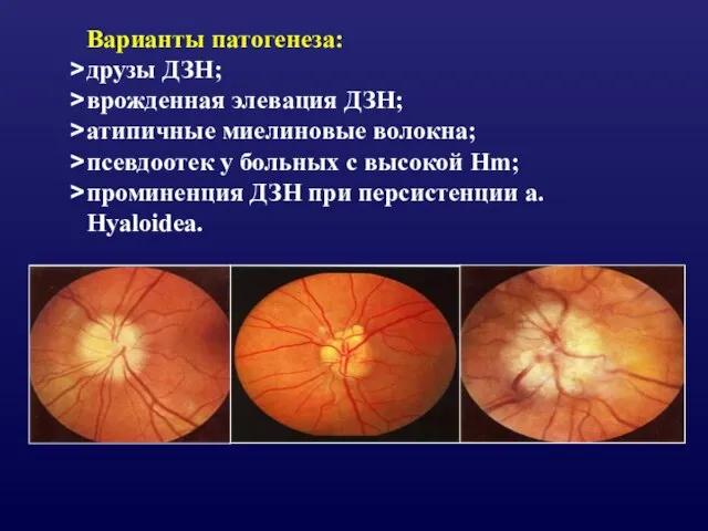 Варианты патогенеза: друзы ДЗН; врожденная элевация ДЗН; атипичные миелиновые волокна; псевдоотек у