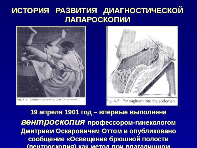 ИСТОРИЯ РАЗВИТИЯ ДИАГНОСТИЧЕСКОЙ ЛАПАРОСКОПИИ 19 апреля 1901 год – впервые выполнена вентроскопия