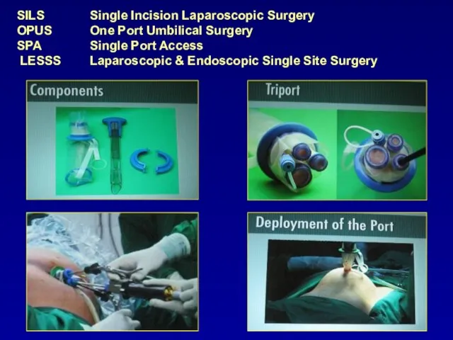 SILS Single Incision Laparoscopic Surgery OPUS One Port Umbilical Surgery SPA Single