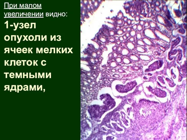 При малом увеличении видно: 1-узел опухоли из ячеек мелких клеток с темными ядрами,