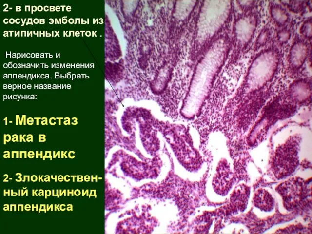 2- в просвете сосудов эмболы из атипичных клеток . Нарисовать и обозначить