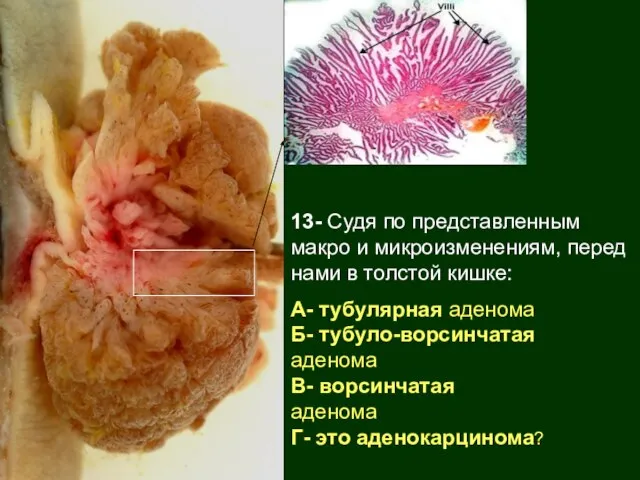13- Судя по представленным макро и микроизменениям, перед нами в толстой кишке: