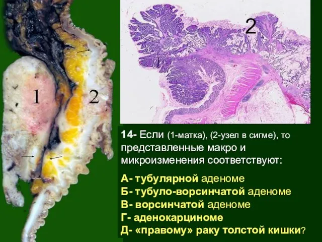 14- Если (1-матка), (2-узел в сигме), то представленные макро и микроизменения соответствуют: