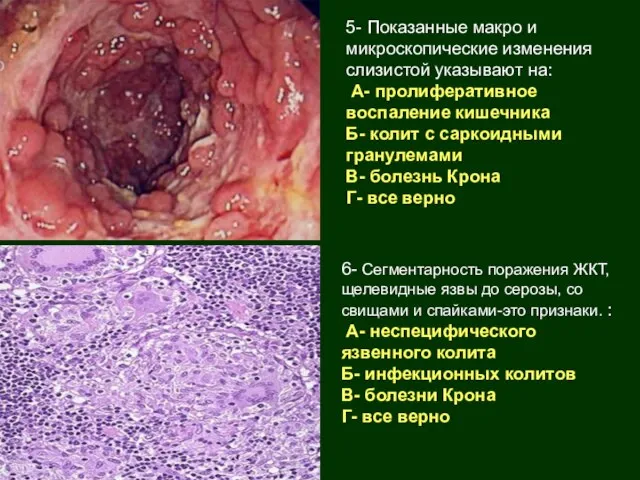 5- Показанные макро и микроскопические изменения слизистой указывают на: А- пролиферативное воспаление