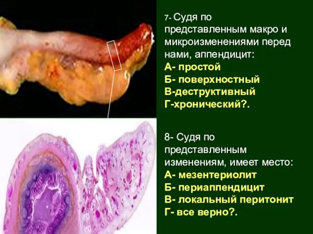 8- Судя по представленным изменениям, имеет место: А- мезентериолит Б- периаппендицит В-