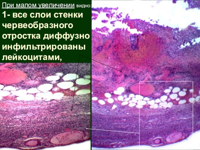 При малом увеличении видно: 1- все слои стенки червеобразного отростка диффузно инфильтрированы лейкоцитами,