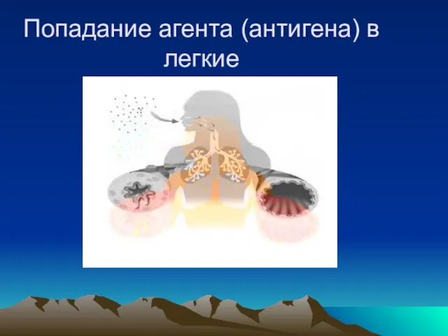 Попадание агента (антигена) в легкие