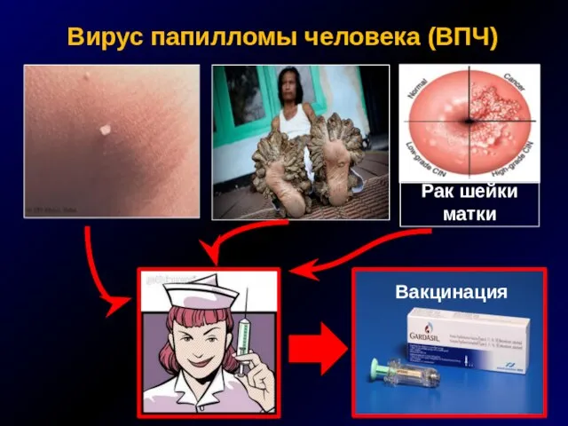 Вирус папилломы человека (ВПЧ) Рак шейки матки Вакцинация