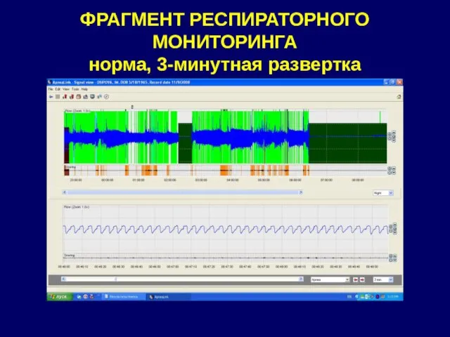 ФРАГМЕНТ РЕСПИРАТОРНОГО МОНИТОРИНГА норма, 3-минутная развертка