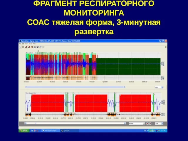 ФРАГМЕНТ РЕСПИРАТОРНОГО МОНИТОРИНГА СОАС тяжелая форма, 3-минутная развертка