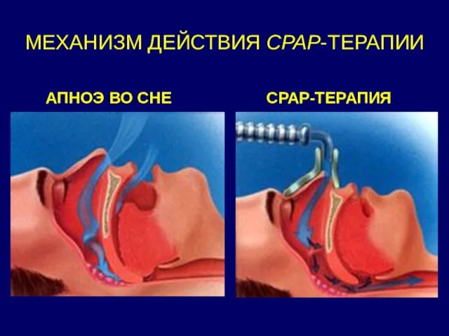 МЕХАНИЗМ ДЕЙСТВИЯ СРАР-ТЕРАПИИ АПНОЭ ВО СНЕ СРАР-ТЕРАПИЯ