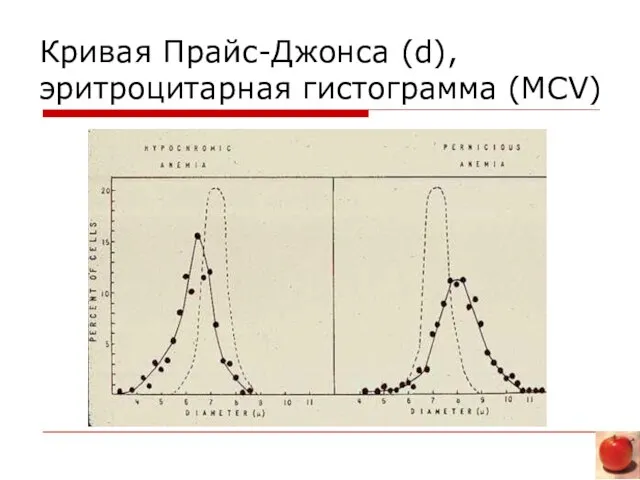 Кривая Прайс-Джонса (d), эритроцитарная гистограмма (MCV)