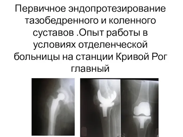 Первичное эндопротезирование тазобедренного и коленного суставов .Опыт работы в условиях отделенческой больницы