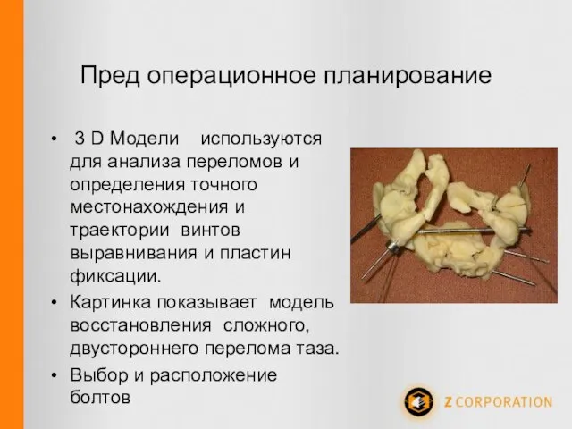 Пред операционное планирование 3 D Модели используются для анализа переломов и определения