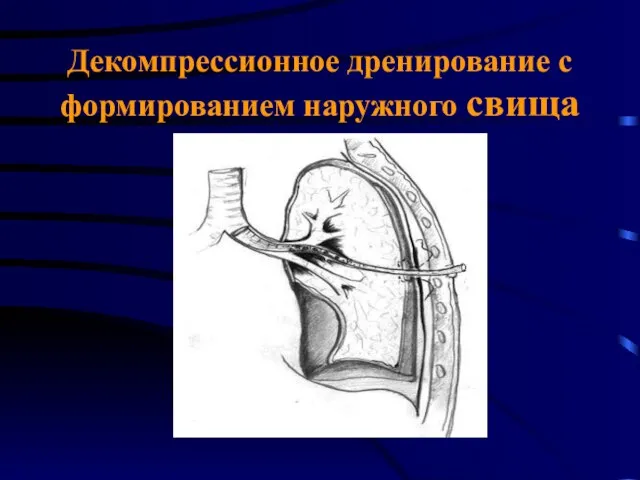 Декомпрессионное дренирование с формированием наружного свища