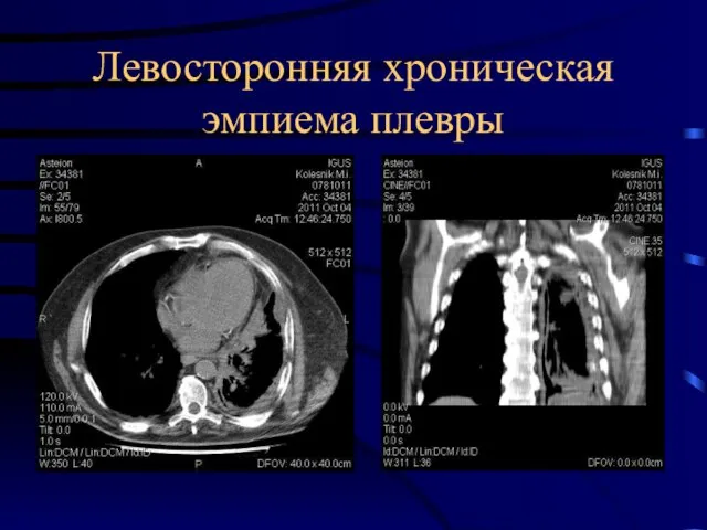 Левосторонняя хроническая эмпиема плевры