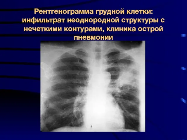 Рентгенограмма грудной клетки: инфильтрат неоднородной структуры с нечеткими контурами, клиника острой пневмонии