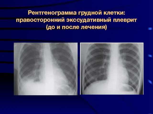 Рентгенограмма грудной клетки: правосторонний экссудативный плеврит (до и после лечения)