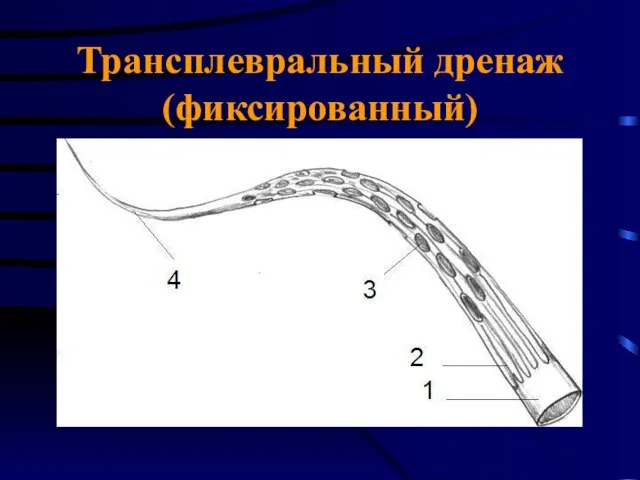 Трансплевральный дренаж (фиксированный)