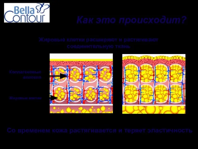 Жировые клетки расширяют и растягивают соединительную ткань Со временем кожа растягивается и