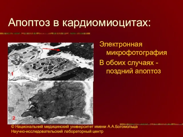 Апоптоз в кардиомиоцитах: Электронная микрофотография В обоих случаях - поздний апоптоз 1