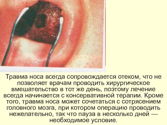 Травма носа всегда сопровождается отеком, что не позволяет врачам проводить хирургическое вмешательство