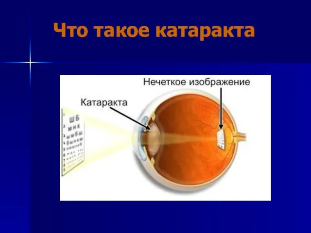Что такое катаракта