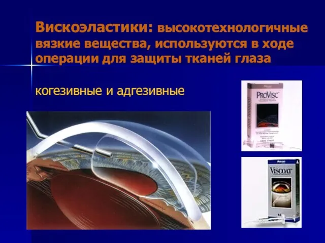 Вискоэластики: высокотехнологичные вязкие вещества, используются в ходе операции для защиты тканей глаза когезивные и адгезивные
