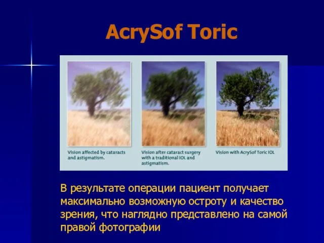 AcrySof Toric В результате операции пациент получает максимально возможную остроту и качество