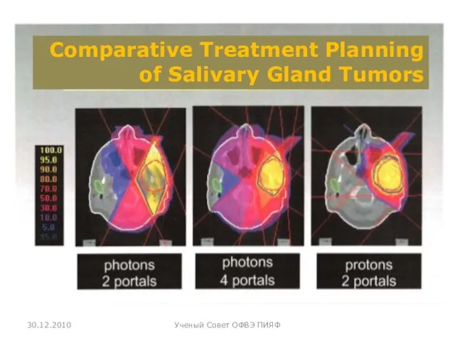 30.12.2010 Ученый Совет ОФВЭ ПИЯФ Comparative Treatment Planning of Salivary Gland Tumors