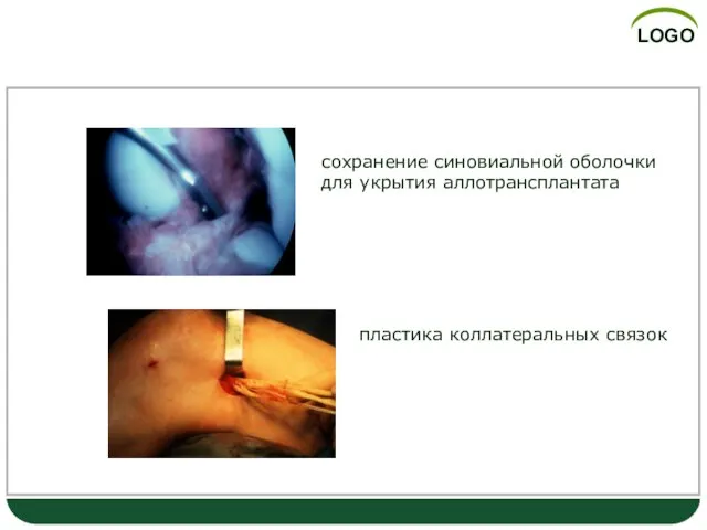 Аллопластика сохранение синовиальной оболочки для укрытия аллотрансплантата пластика коллатеральных связок