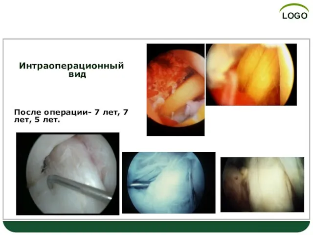 АЛЛО трансплантаты Интраоперационный вид После операции- 7 лет, 7 лет, 5 лет.