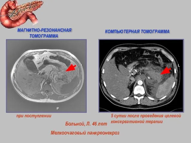 при поступлении Больной, Л. 46 лет Мелкоочаговый панкреонекроз 5 сутки после проведения