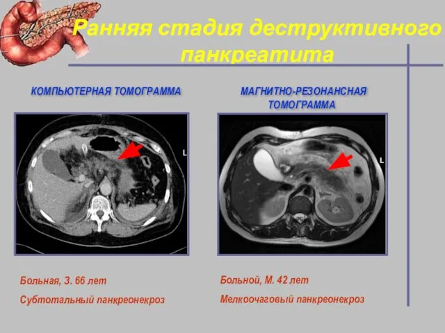 Ранняя стадия деструктивного панкреатита Больная, З. 66 лет Субтотальный панкреонекроз КОМПЬЮТЕРНАЯ ТОМОГРАММА