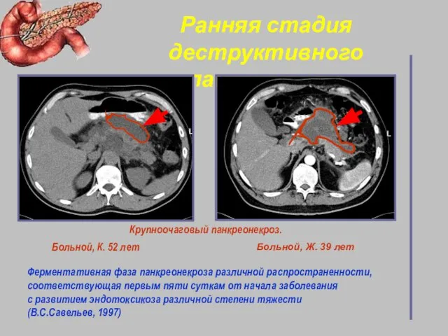 Ранняя стадия деструктивного панкреатита Ферментативная фаза панкреонекроза различной распространенности, cоответствующая первым пяти