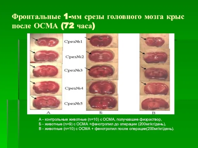 Фронтальные 1-мм срезы головного мозга крыс после ОСМА (72 часа) А -
