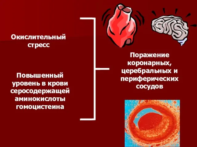 Окислительный стресс Повышенный уровень в крови серосодержащей аминокислоты гомоцистеина Поражение коронарных, церебральных и периферических сосудов