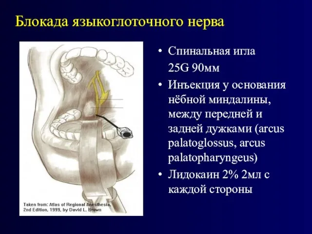Блокада языкоглоточного нерва Спинальная игла 25G 90мм Инъекция у основания нёбной миндалины,