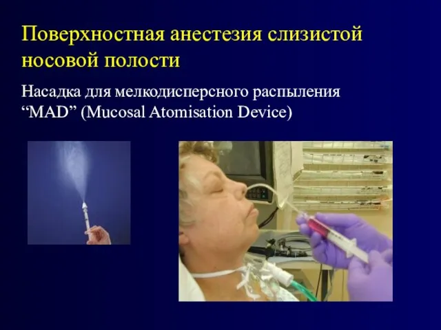 Поверхностная анестезия слизистой носовой полости Насадка для мелкодисперсного распыления “МAD” (Mucosal Atomisation Device)