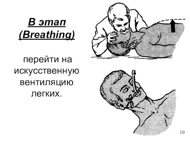 B этап (Breathing) перейти на искусственную вентиляцию легких. 10