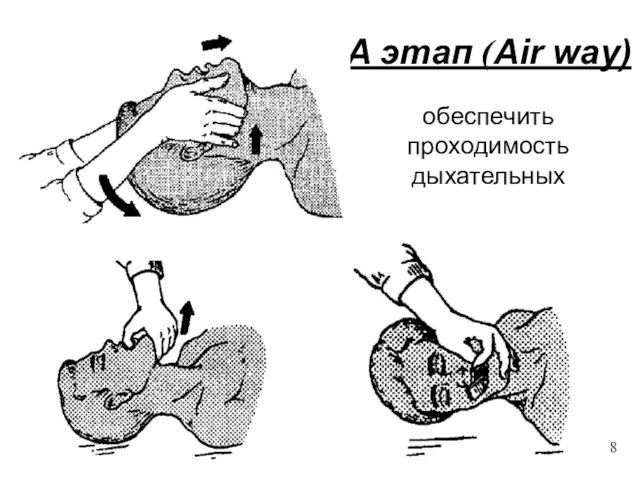 A этап (Air way) обеспечить проходимость дыхательных 8