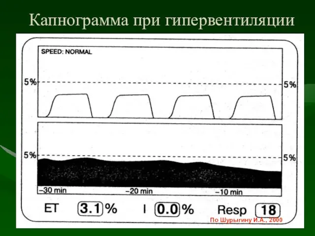 Капнограмма при гипервентиляции По Шурыгину И.А., 2000