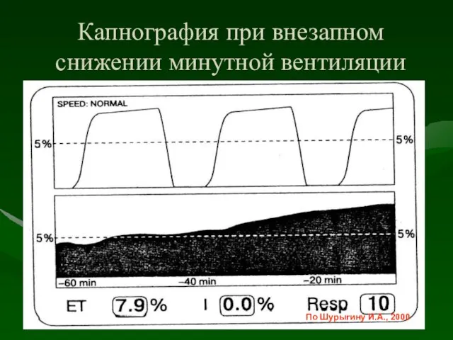 Капнография при внезапном снижении минутной вентиляции По Шурыгину И.А., 2000