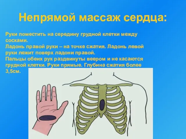 Непрямой массаж сердца: Руки поместить на середину грудной клетки между сосками. Ладонь